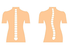 脊柱侧弯的测量方法以及判定标准解读