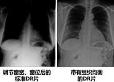 影响医用X射线影像设备成像质量的主要指标和因素