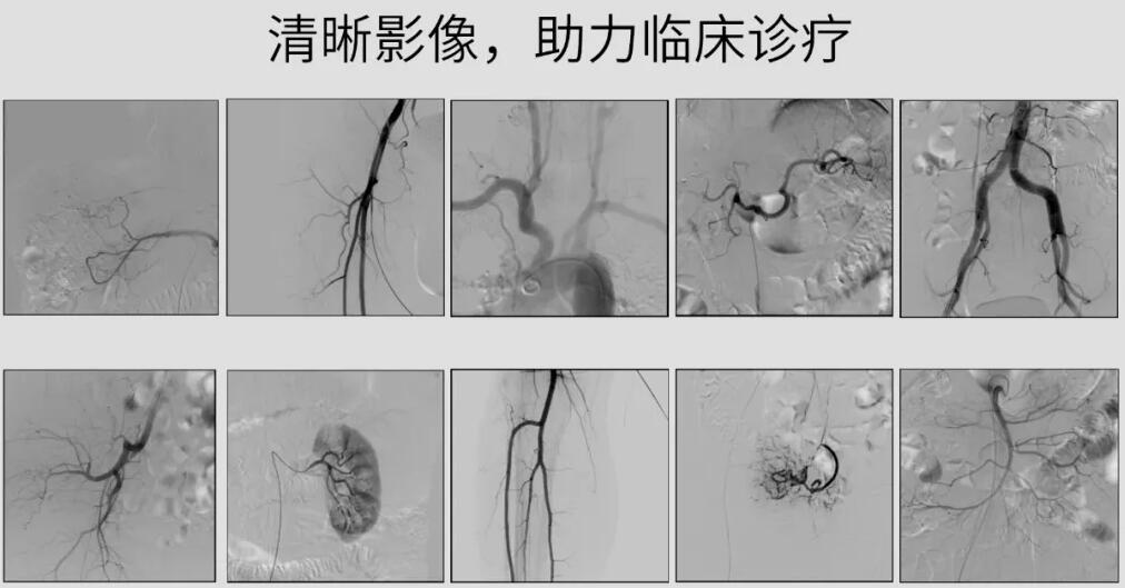 介入c臂机高清影像