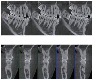 口腔CBCT 多平面组合重建