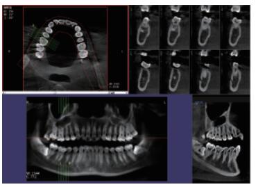 口腔CBCT三维影像