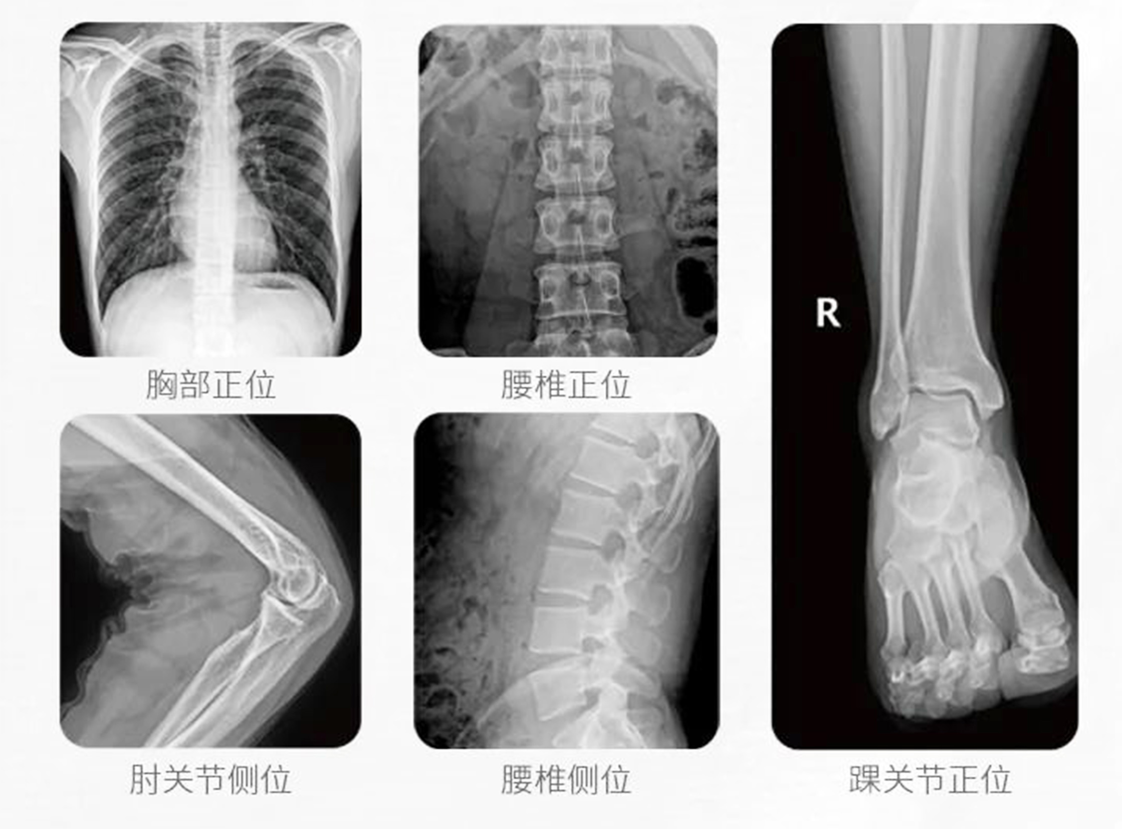 移动式DR临床影像