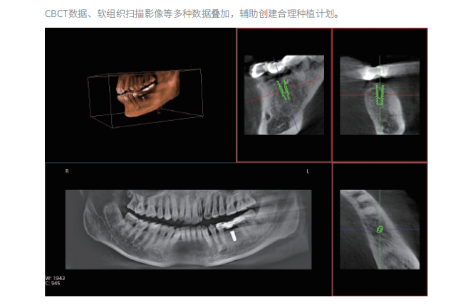 大视野口腔CBCT影像