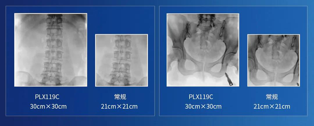 移动式平板C臂视野