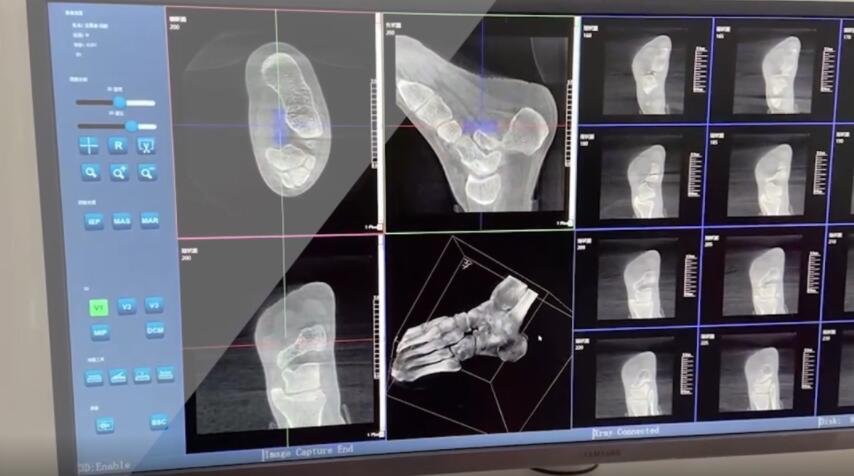 【医疗科普】：踝关节三维扫描