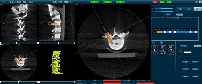 脊柱手术机器人准确定位