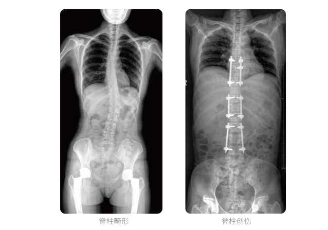 动态DR的全脊柱临床影像