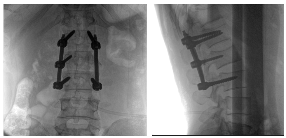一体式C形臂全节段腰椎临床影像
