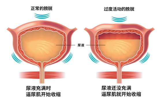 膀胱过度活动症(OAB)示意图