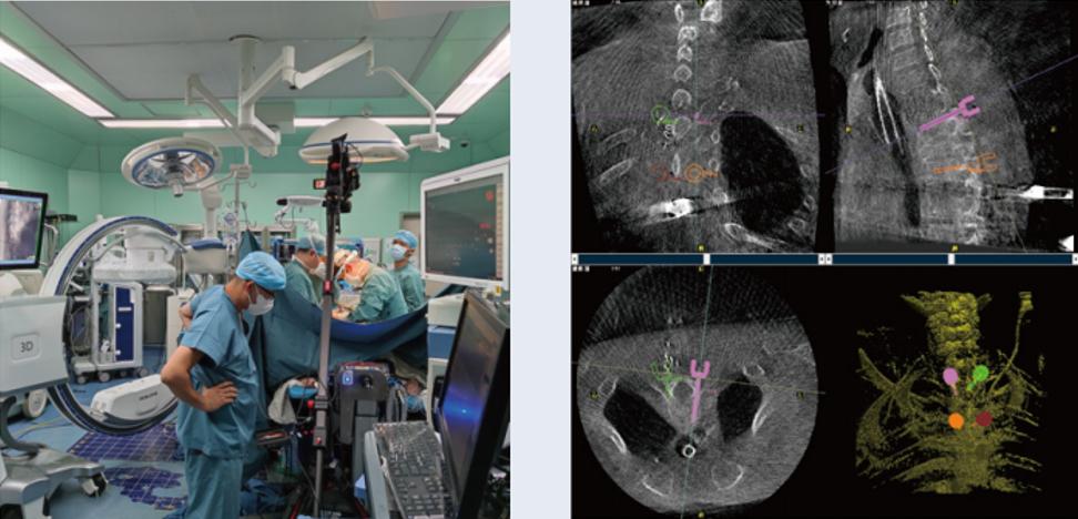 术中三维C形臂影像在脊柱导航机器人系统中的应用