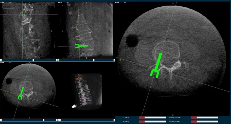 术中三维CT辅助手术机器人