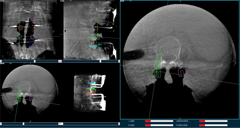 机器人辅助腰椎后路侧弯矫形手术规划图像