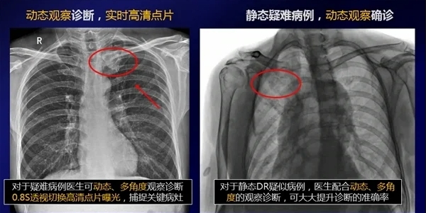 动态DR和静态DR图像对比